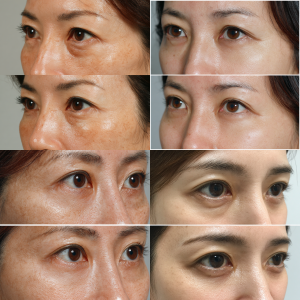 幹細胞治療症例写真:目の下のクマ治療