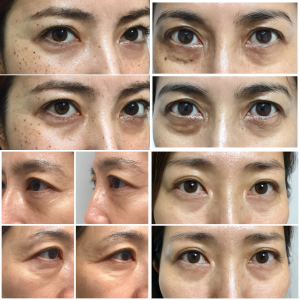 幹細胞治療症例写真:目の下のクマ治療