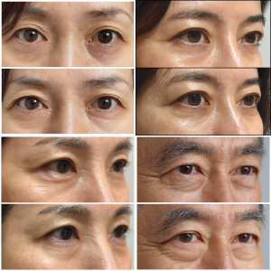 幹細胞治療症例写真:目の下のクマ治療